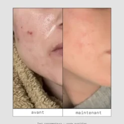 Skin & Out Mini routine spéciale boutons Minis Shtars
